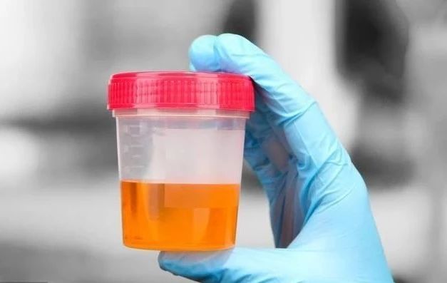 符合这5个指标?警告你,尿毒症风险很大,抓紧住