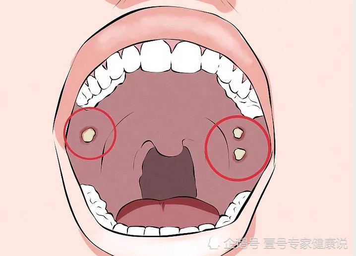 口腔癌危险信号:嘴里出现这种颜色的斑块,你应该去看
