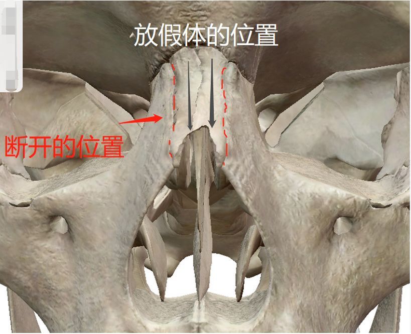 刚补完针的气球脸、杨蓉宽成护城河的新鼻子,