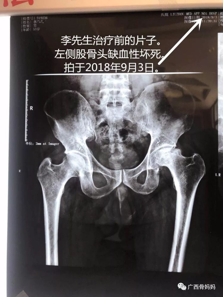 股骨头坏死(左侧晚期)经中医治疗,广西李先生左侧股骨头活过来啦:治疗