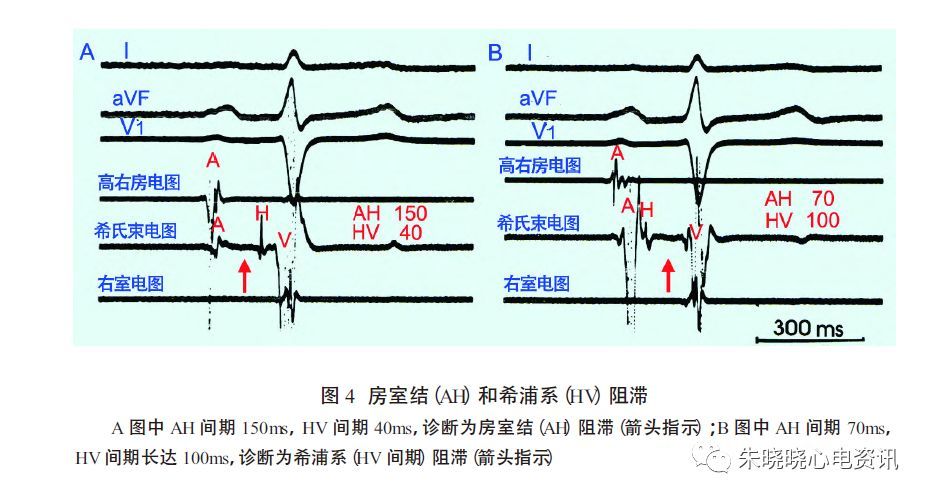 郭继鸿教授房室阻滞部位的心电图诊断