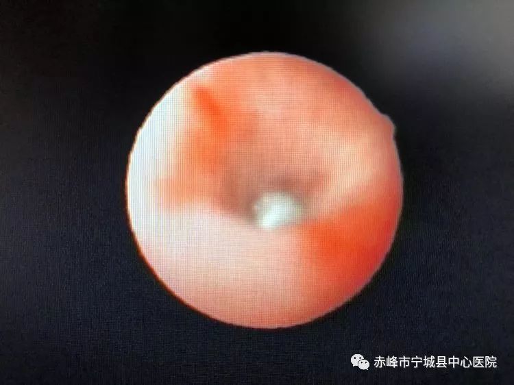 痰栓 腾讯网
