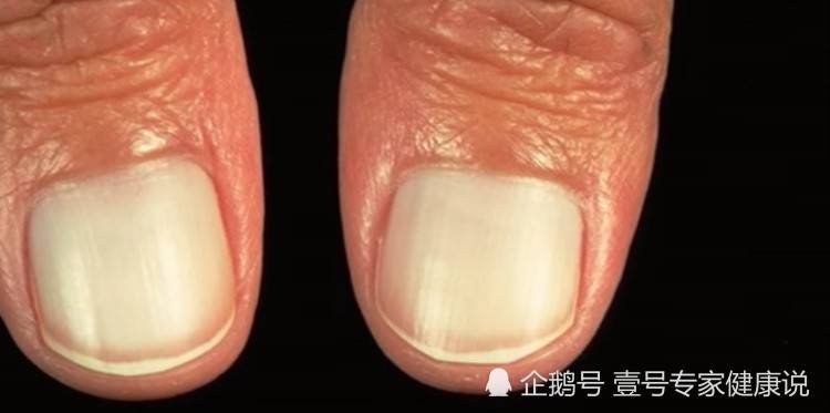 指甲出现这种变化,一查竟是肝硬化!如果你是这样,赶紧