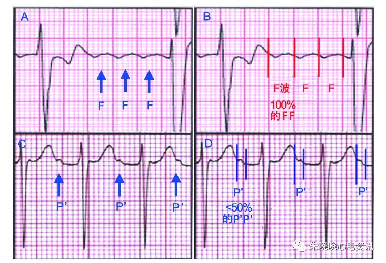 心房扑动f波的分期