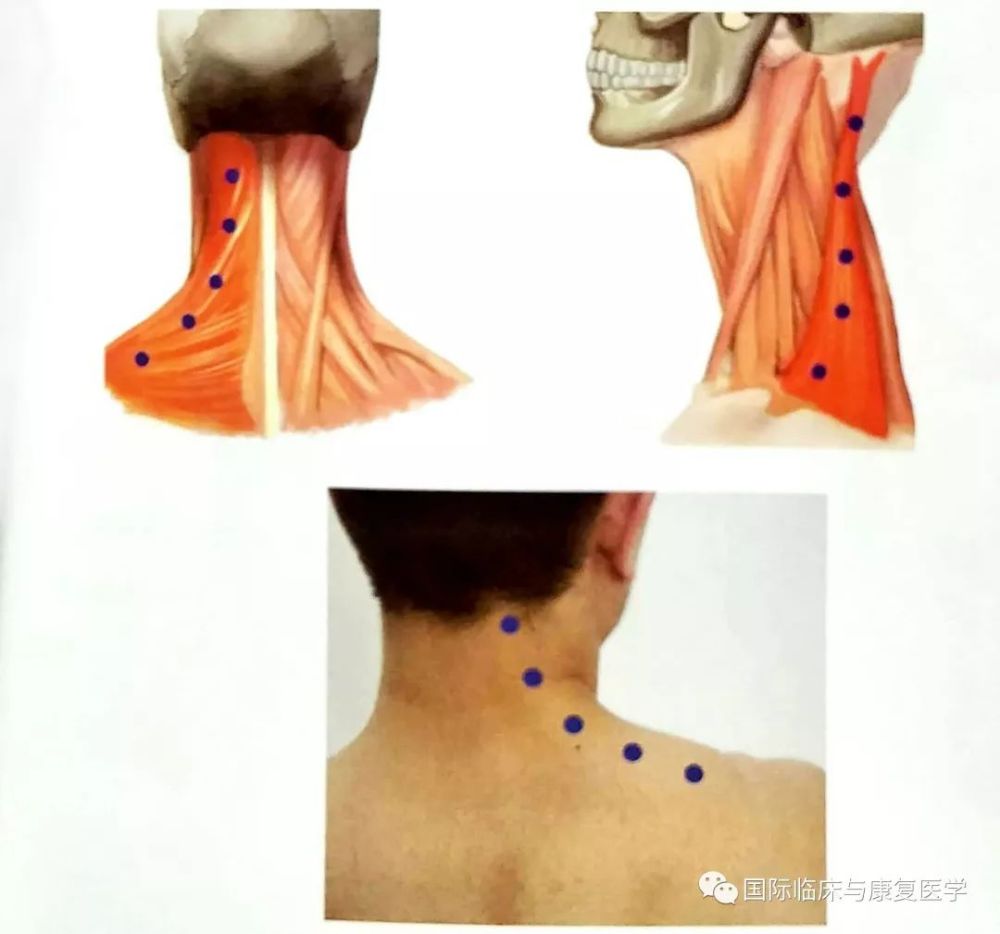 颈部常用注射部位的解剖及肉毒毒素注射方案