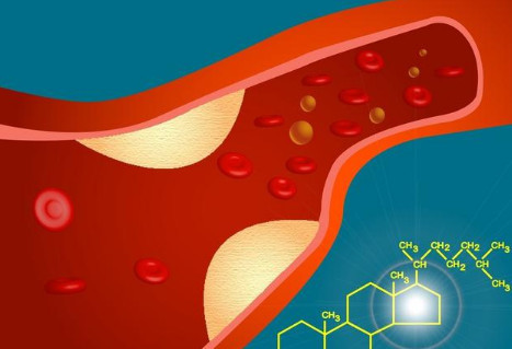 颈动脉斑块,一定要吃他汀药吗?长期吃瑞舒伐他