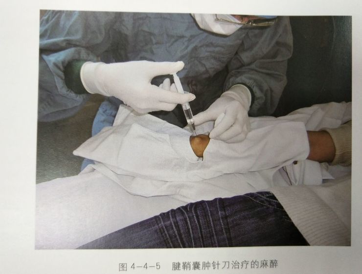 腕背部腱鞘囊肿的针刺治疗