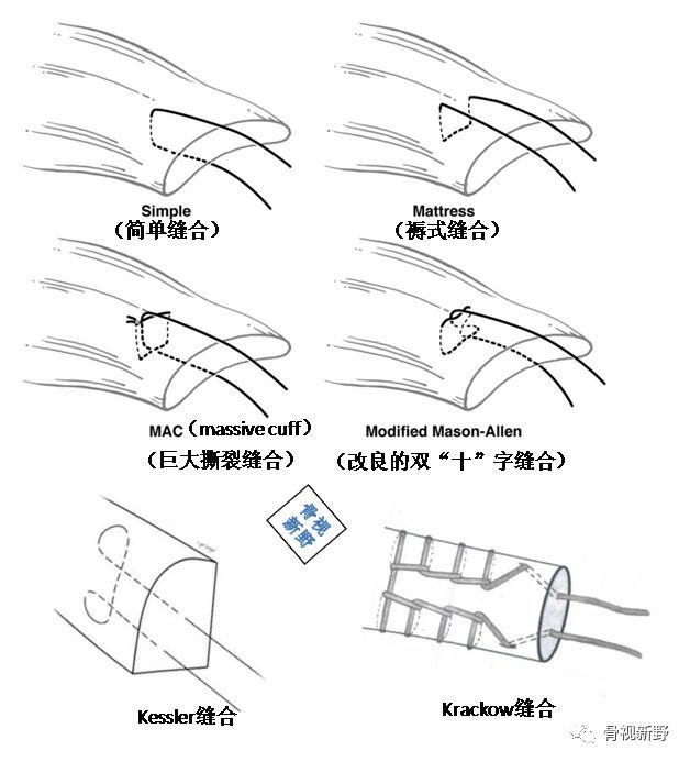 操作方法 常见的肌腱缝合术式