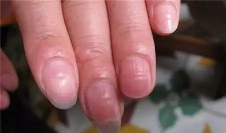 营养不良有些人的指甲,表面会出现一条线形凹陷,西医学上把它称为