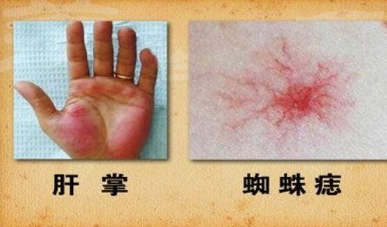 手上出现肝掌是怎么回事?今天就给大家讲解一