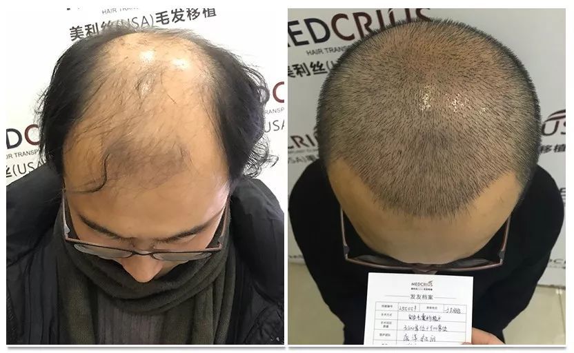 2018年12月20日 植发后的第10天与术前正面照片对比,原来光秃的头顶