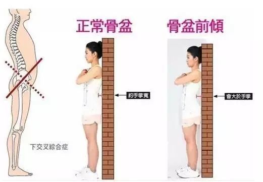 骨盆前倾or外扩怎么办?