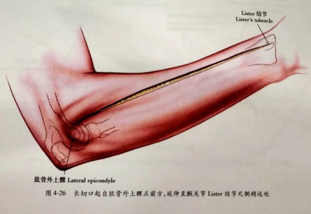 做一直切口,自肱骨外上髁前方(沿前臂背面)延伸至腕部 lister结节尺侧