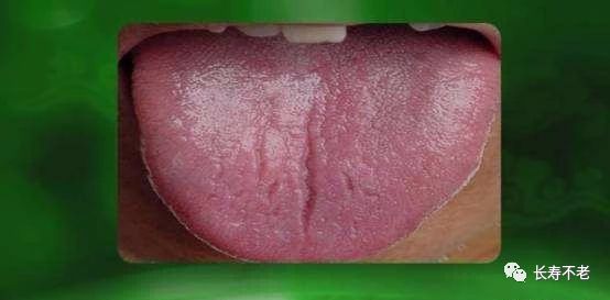 一,裂纹舌三大舌质表明身体可能有问题:舌苔,是舌体上附着的一层苔状