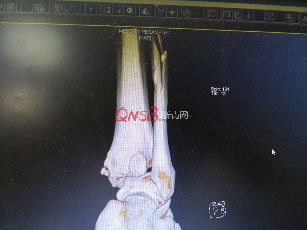 随后,她被送到了附近的医院拍了片,发现右脚骨折后,又来到了浙江省