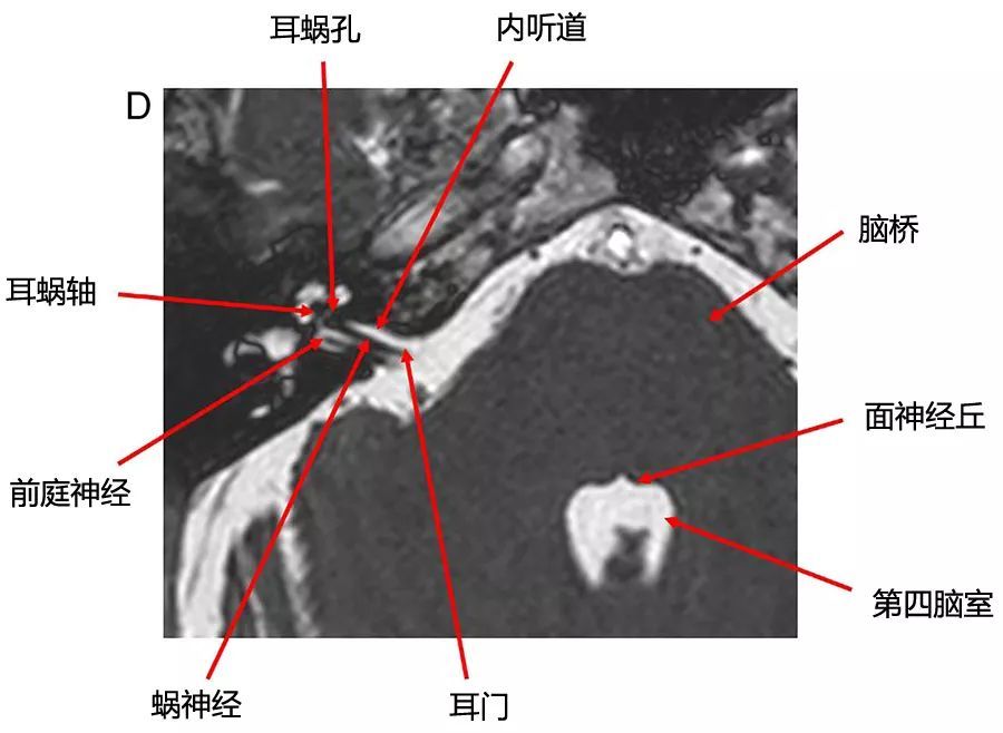 15张图谱轻松掌握:桥小脑角区正常解剖及常见病变