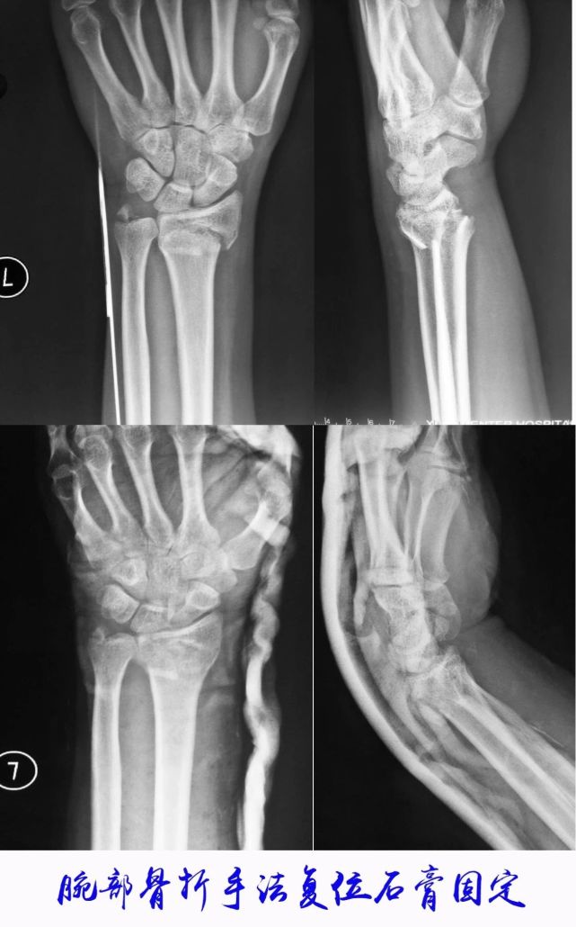 风雪来袭 家中老人怎样防跌倒?西安市中心医院