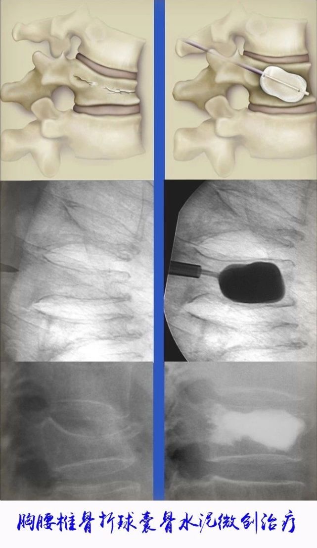 风雪来袭 家中老人怎样防跌倒?西安市中心医院