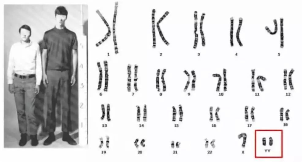 核型为(47,xyy); 女性多了一条(或几条)x染色体,则为 "超雌综合征