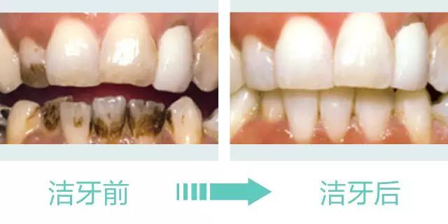 洗牙洗牙洗牙现在明白了牙医的苦心