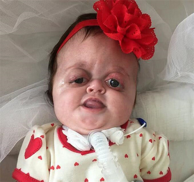 产检查出是畸形儿，孕妇坚持生下，2年后网友:你还不如杀了她