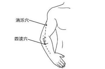 偏头痛.此类病人四渎穴常有压敏反应,针之止痛.五十四,翳风1.