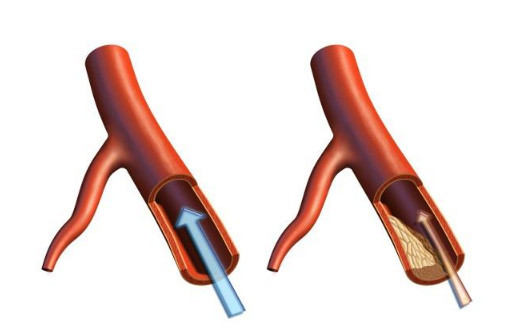 高血脂到底是什么意思?真相看这里