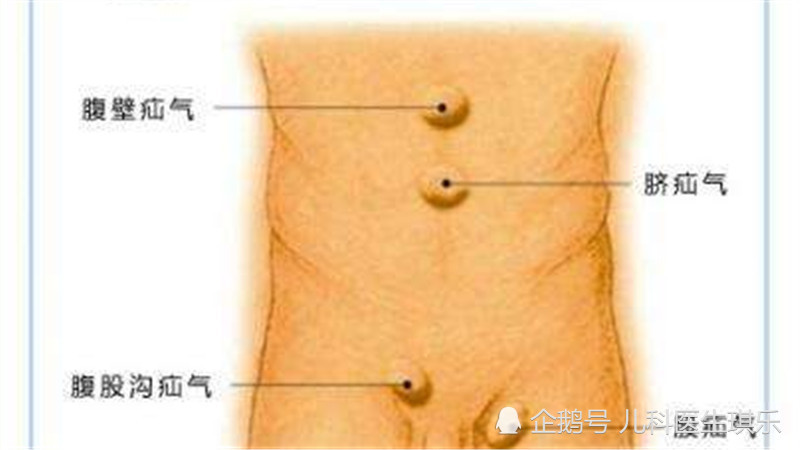 宝宝疝气是个什么鬼,需不需要手术治疗?