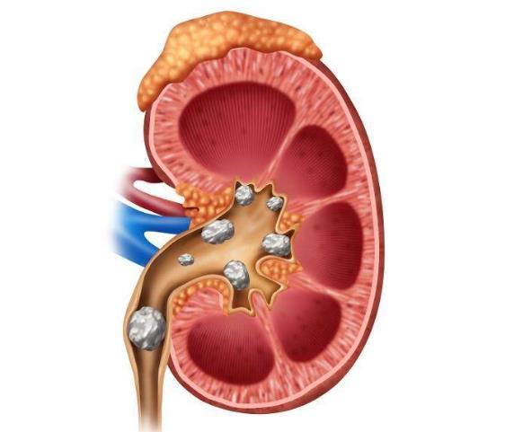 身体若有这3个表现,可能是肾脏长"石头",及时查一查
