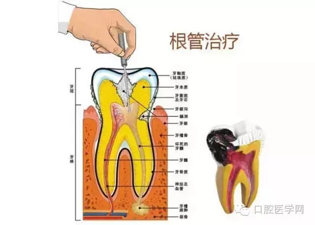 根管治疗就是抽牙神经吗