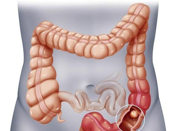患上"肠息肉",大便时可能有3个"异常",为了健康不妨
