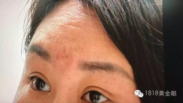 打玻尿酸防小三？上海女子花十幾萬美容現在后悔了