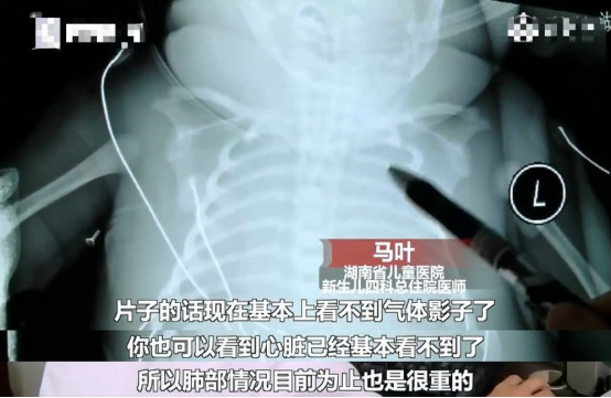 妇在家生子用未消毒剪刀剪脐带,导致新生儿感