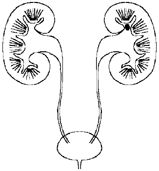尿酸,磷酸钙,磷酸镁等为主要成分的结晶体形成的异物,导致泌尿系统