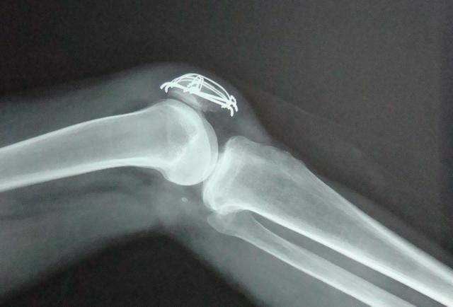 膝关节疼痛肿胀有积液,别发愁了!医生教你3招