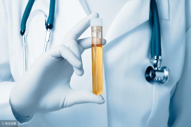 尿液检查是诊断慢性肾病不可缺少的检查项目,其中包括24小时尿蛋白