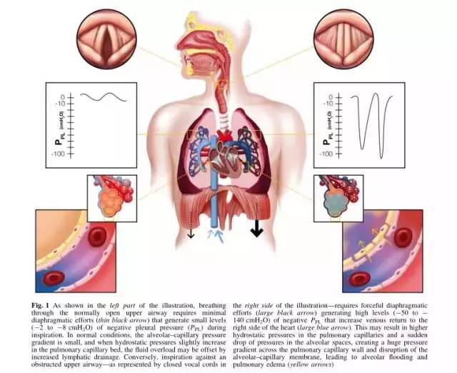 (negative pressure pulmonary edema nppe)是非心源性肺水肿的一种