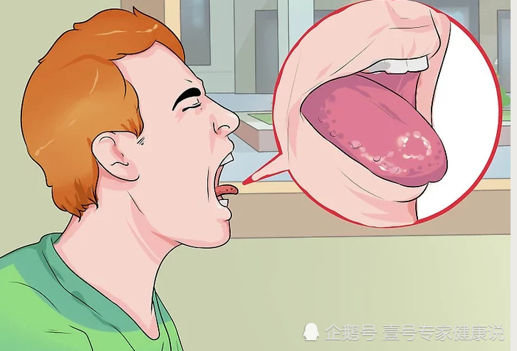 得这种病的时候,你会发现舌头上好像多了厚厚一层白色,所以它也叫雪口