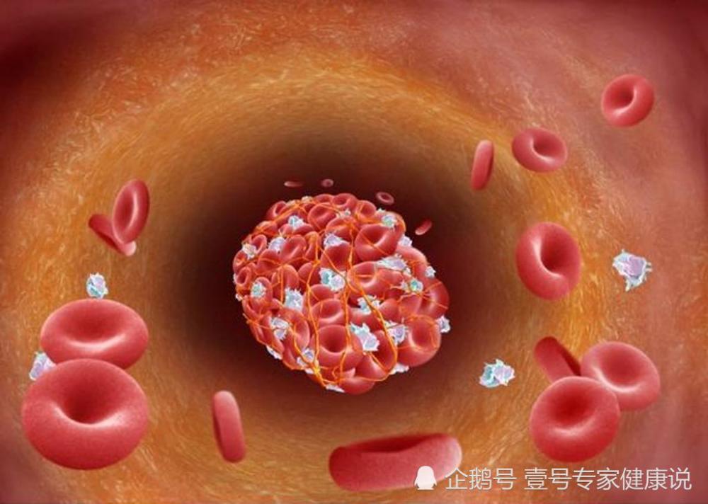 不论是久坐还是久站,腿上出现这4个信号,十有