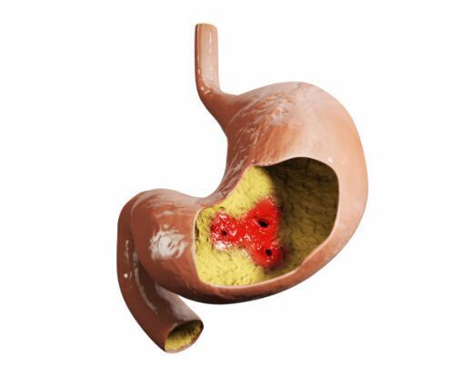 幽门螺旋杆菌这5个传染途径,需警惕,了解后最