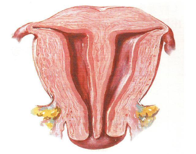 纵隔子宫是胚胎时期子宫段副中肾管融合异常所致,是最常见的子宫畸形