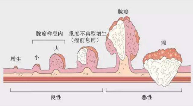 某些息肉的恶变过程大致遵循: 小息肉→大息肉→上皮内瘤变→原位癌