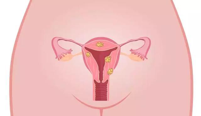 34岁未婚女肚大如怀孕7月,医生一查,肚子竟长