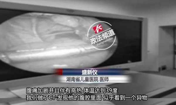 3岁男童持续高烧、腹痛20多天,阑尾化脓!只因