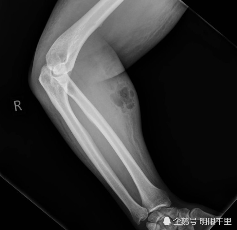 x光片显示该男子手臂肌肉内有肿胀和空气