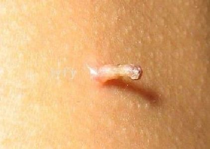 脖子上长小肉粒?原来这是一种病|丝状疣|医生|皮赘|二氧化碳激光|腋下