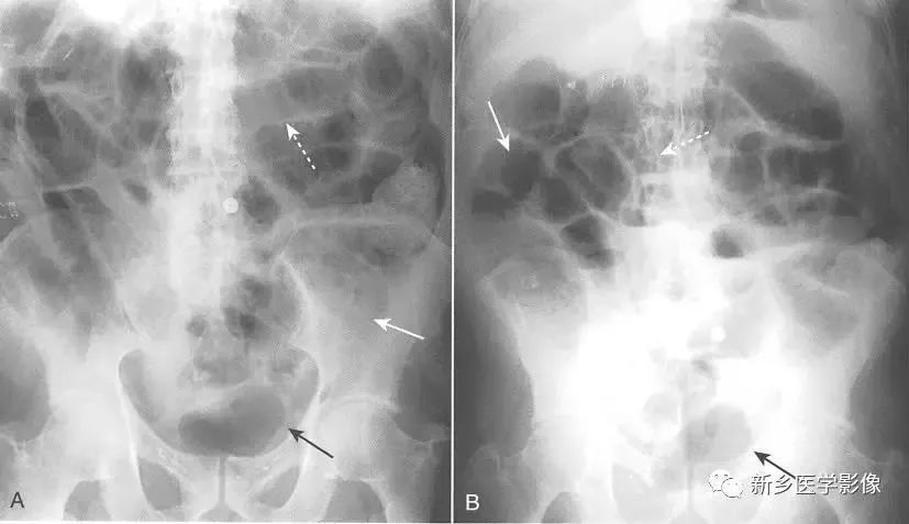 诊断误区:认识弥漫性麻痹性肠梗阻.