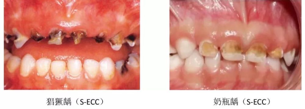 儿童龋病的病因是什么,快来看看这份风险评估吧