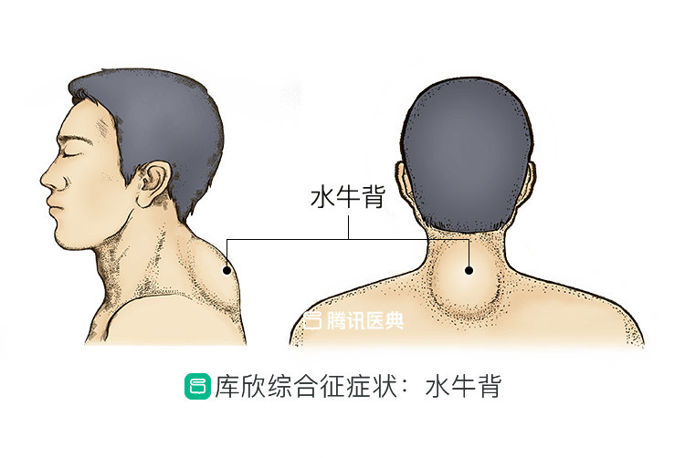 库欣综合征是由于下丘脑-垂体-肾上腺 (hpa) 轴调控失常,肾上腺皮质