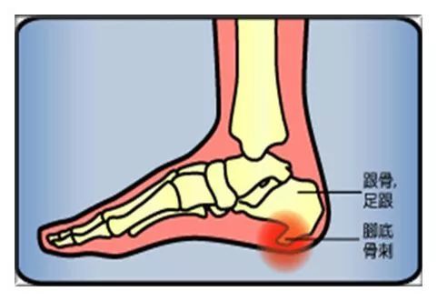 外治跟骨骨刺一绝